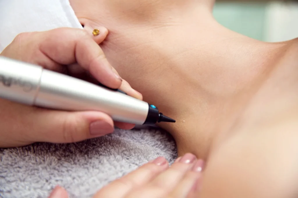 CryoPen precisely treating Molluscum Contagiosum lesions, showing safe and effective removal for faster healing by Cryosonic Cheltenham