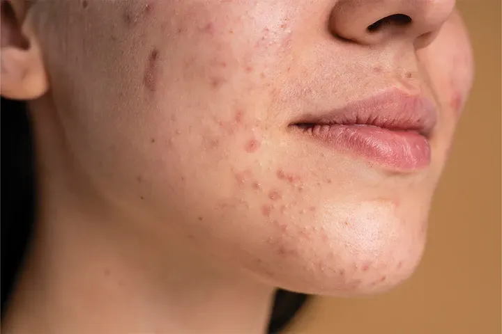 CryoPen precisely removing Skin Tags (fibroepithelial polyps), showing safe and effective treatment for smoother, clearer skin Cheltenham